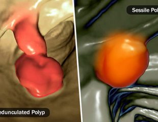 مواردی که نیاز است در مورد پولیپ بدانیم