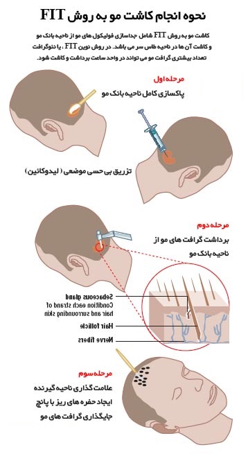 مراحل کاشت مو به روش fit