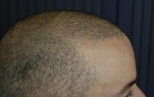 کاشت مو به روش BHT کاشت مو به روش BHT