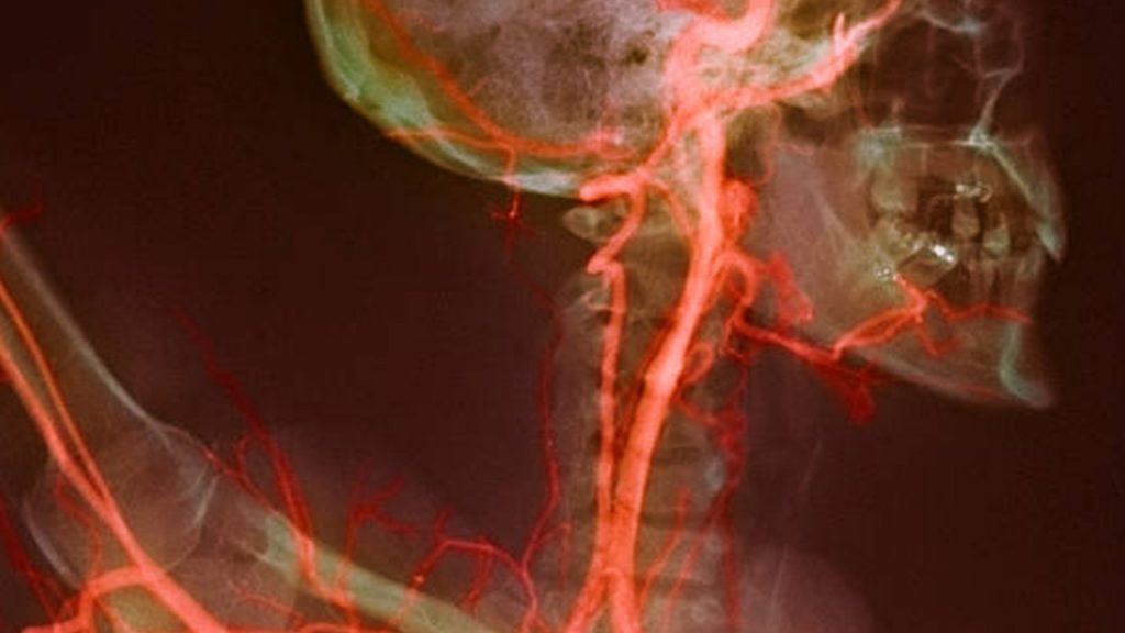 بیماری سرخرگ کاروتیدی : دلایل ، علائم ، تست ها و درمان