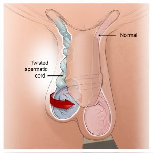 تورشن بیضه یا پیچ خوردگی بیضه  2