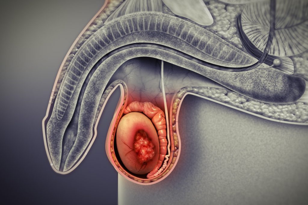 سرطان بیضه - سرطان نادر اما قابل درمان