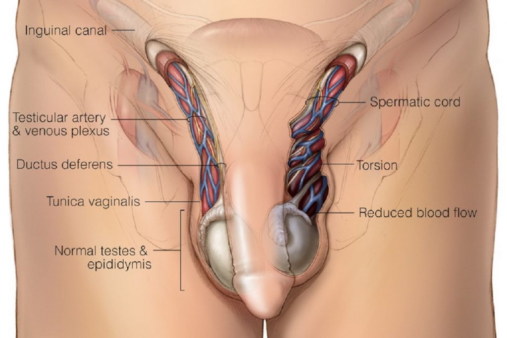 تورشن بیضه یا پیچ خوردگی بیضه چیست؟