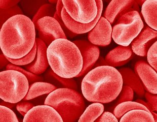 ترومبوسیتوزیس یا افزایش پلاکت خون به چه معنا است؟