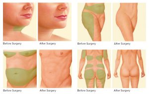 1- لیپوساکشن (Liposuction)