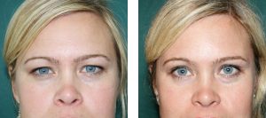 3- عمل جراحی پلک (Blepharoplasty)