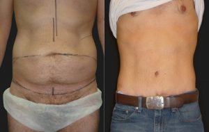 4- ابدومینوپلاستی (Abdominoplasty)