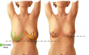 5- کوچک کردن سینه (Breast Reduction)