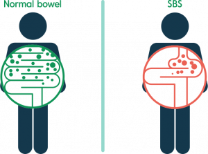 سندرم روده کوتاه یا Short Bowel Syndrome 2