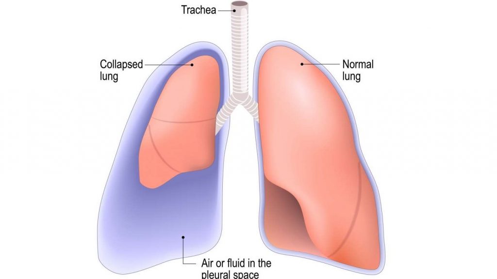 آتلکتازی ریه - وقتی ریه‌ها روی هم بخوابند چه اتفاقی می‌افتد؟