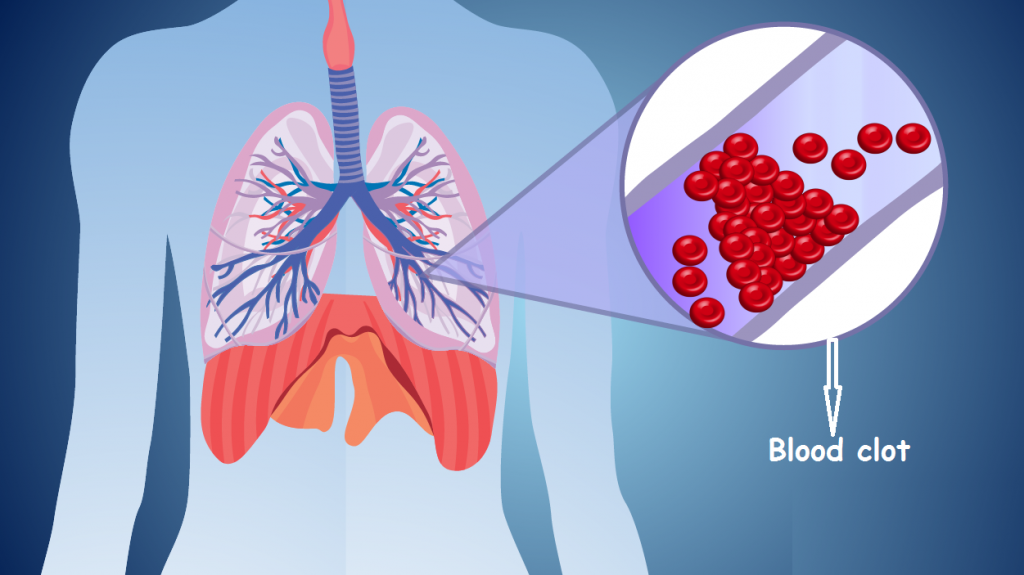 چگونه بفهمیم آمبولی ریه داریم؟ علائم این عارضه چیست؟