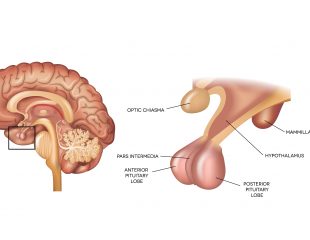 تومور هیپوفیز چه تغییراتی در بدن ایجاد می‌کند؟