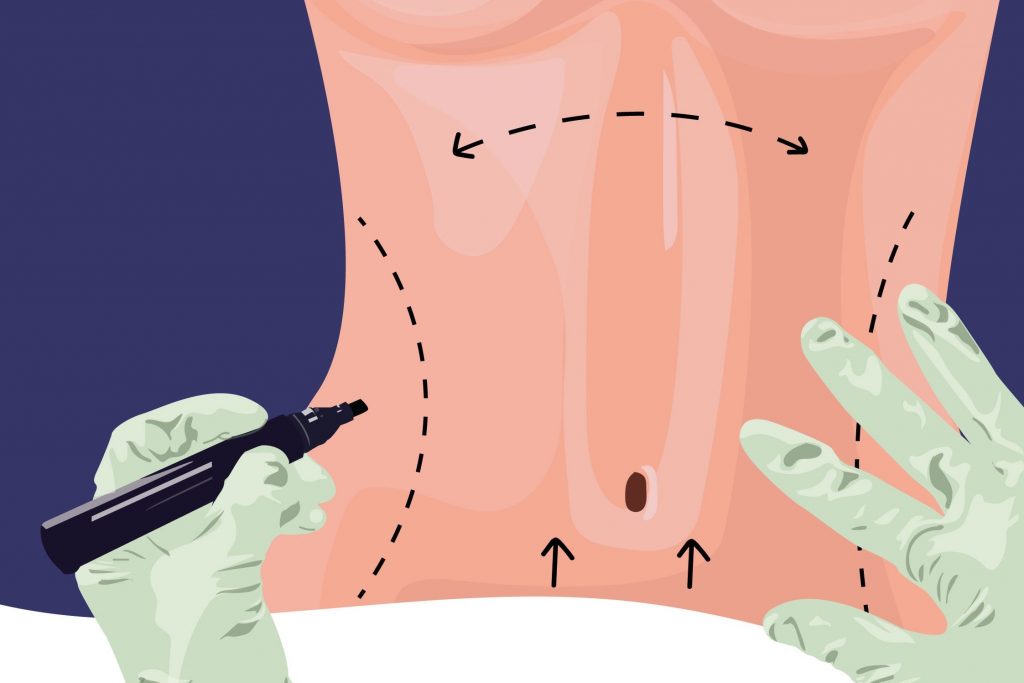 هرآنچه که باید درباره عمل جراحی تامی تاک یا ابدومینوپلاستی بدانید