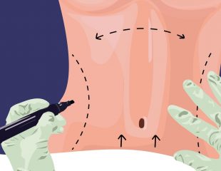 هرآنچه که باید درباره عمل جراحی تامی تاک یا ابدومینوپلاستی بدانید