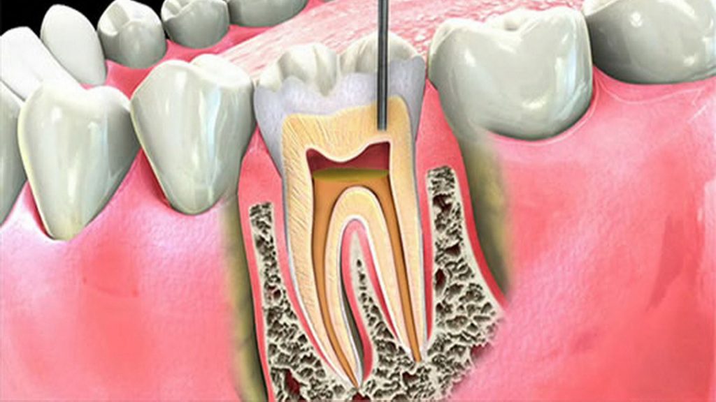 تفاوت یک اندودنتیست با دندانپزشک چیست؟