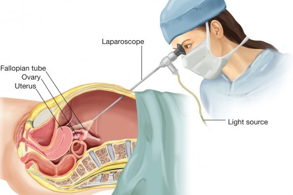 دوره بهبودی عمل جراحی لاپاراسکوپی آندومتریوز چگونه است؟