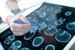 نوروسایکولوژیست یا عصب روانشناس کیست؟ نوروسایکولوژیست یا عصب روانشناس کیست؟