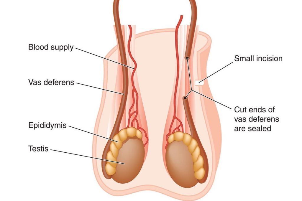 چگونه می توان عمل جراحی وازکتومی را معکوس کرد؟