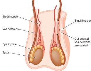 چگونه می توان عمل جراحی وازکتومی را معکوس کرد؟