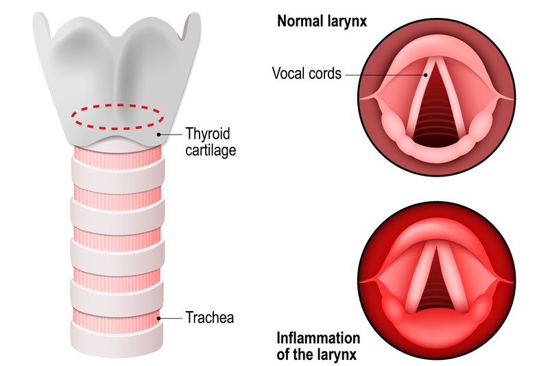 لارنژیت مزمن چیست؟