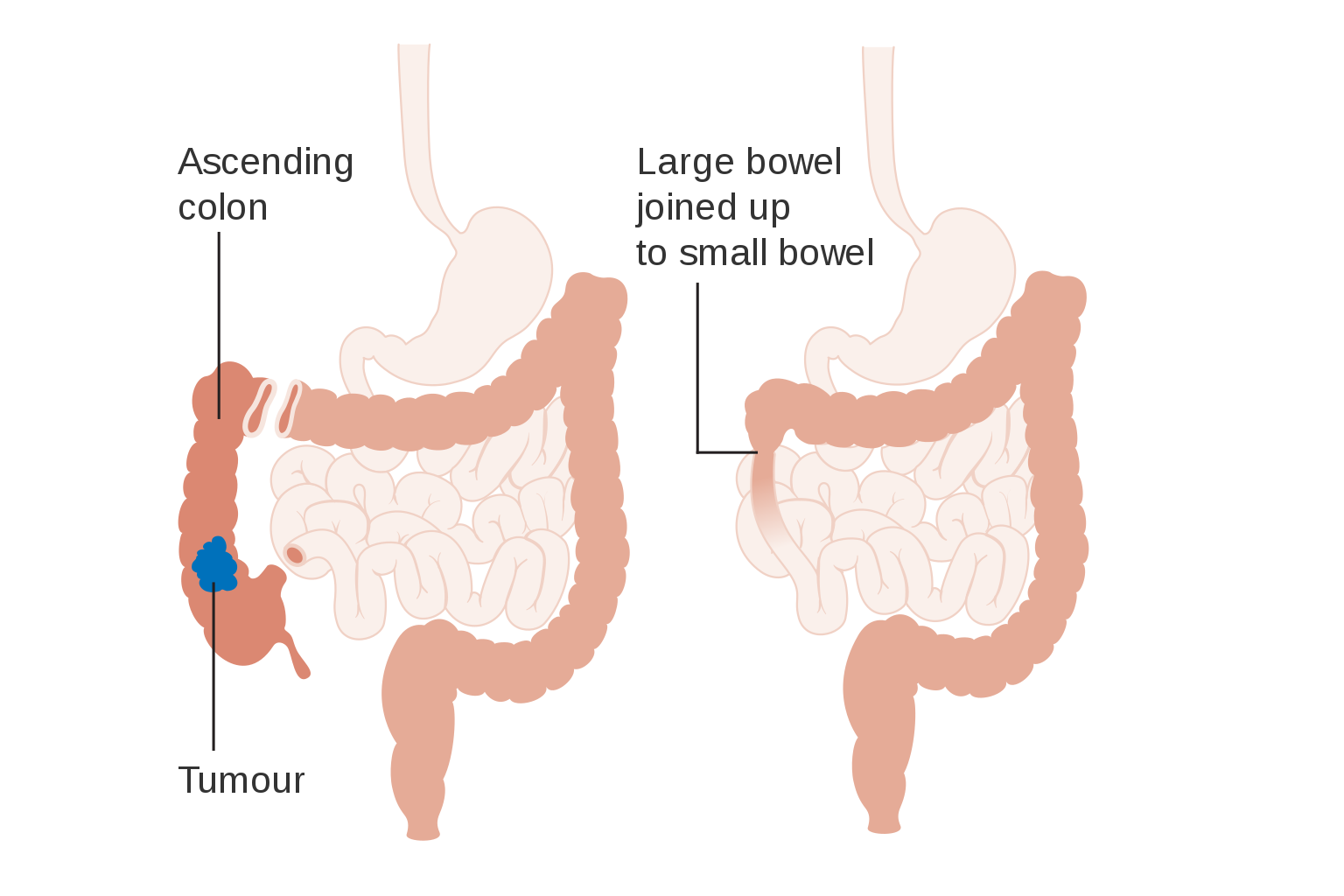 آشنایی با عمل جراحی همی کولکتومی - نسخه