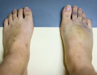 پای بنفش - علت کبود شدن پاها چیست؟