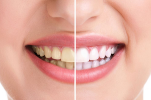 چگونه از شر رنگ زرد دندان ها خلاص شویم؟ چگونه از شر رنگ زرد دندان ها خلاص شویم؟