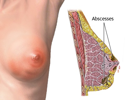 عفونت مرکزی یا زیر نوک پستانی