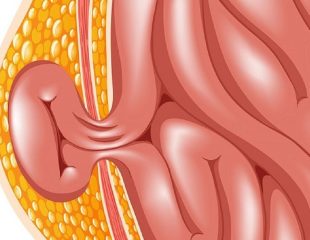 فتق یا هرنی چیست و برای درمان آن چه باید کرد؟