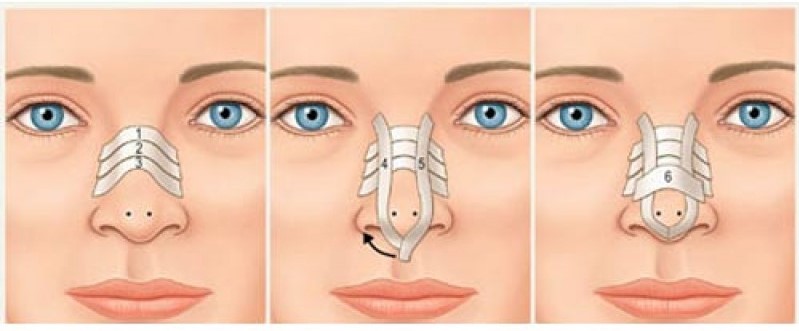 تفاوت چسپ زدن بینی بعد از عمل جراحی رینوپلاستی در افراد مختلف