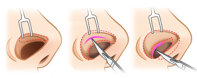 مقدمه ای بر جراحی بینی بسته (Closed rhinoplasty)
