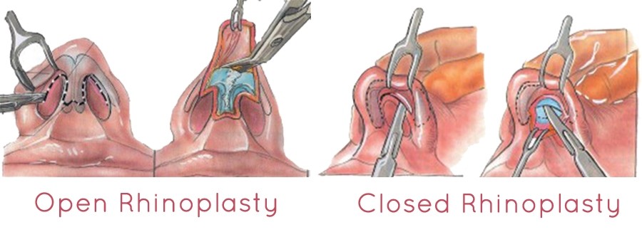 روش‌های مختلف عمل رینولاستی یا عمل جراحی بینی گوشتی
