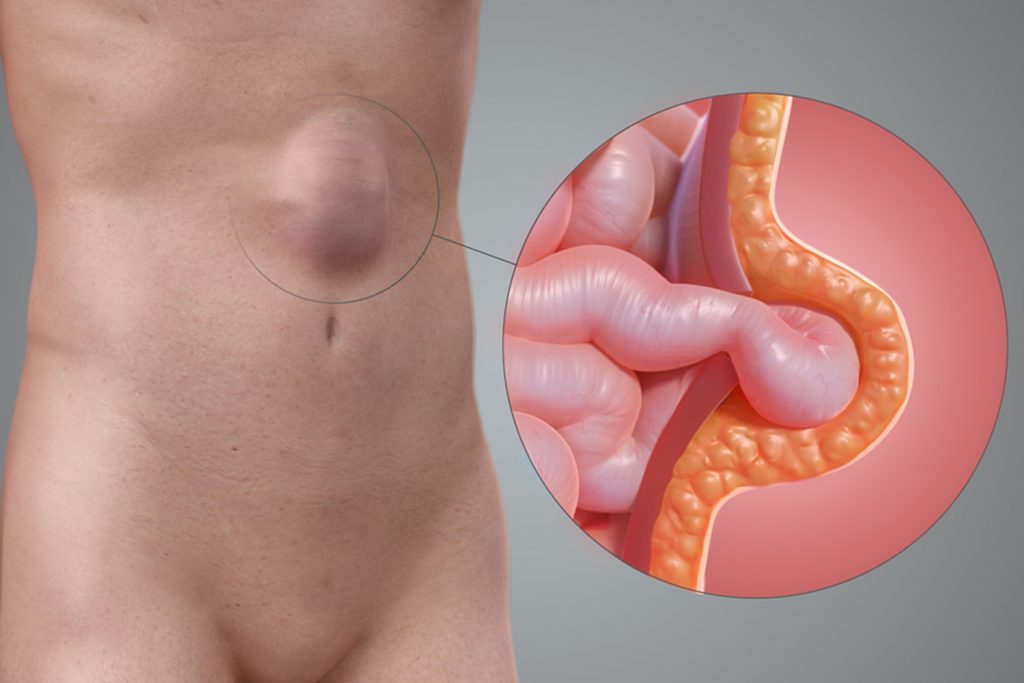 ناگفته هایی درباره فتق شکمی ونترال و نحوه درمان آن