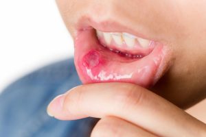 سرطان لب چگونه ایجاد می شود؟ سرطان لب چگونه ایجاد می شود؟