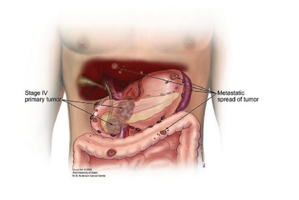 مرحله 4 سرطان لوزالمعده یا پانکراس