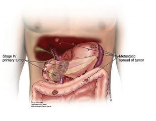 مرحله 4 سرطان لوزالمعده یا پانکراس