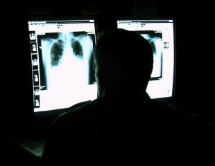 تشخیص کرونت با اشعه ایکس و سی تی اسکن