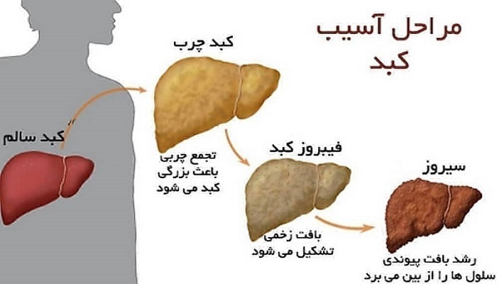 مراحل کبد چرب