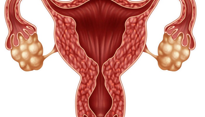 آشنایی با کیست تخمدان