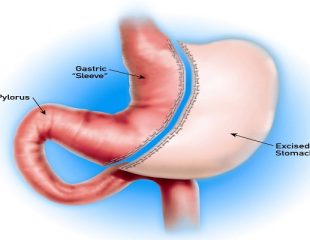 اسلیو معده- عمل جراحی معده