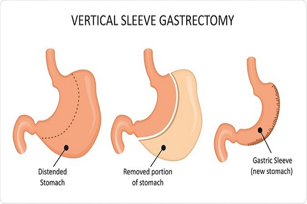 عمل جراحی لاغری- اسلیو معده