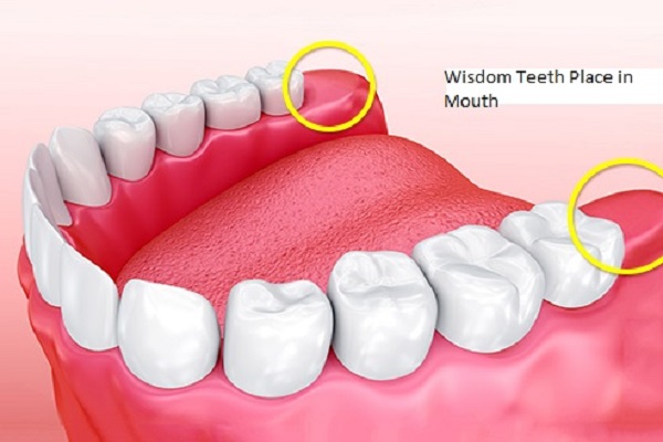 دندان عقل و محل آن در دهان