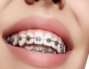 روش ارتودنسی ثابت دندان ها