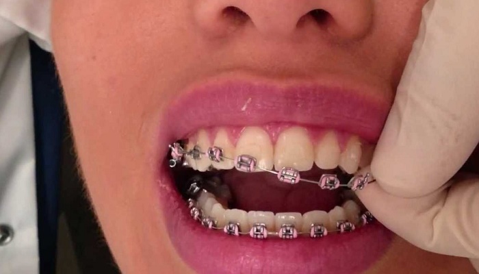 ارتودنسی-دندان -چه-زمانی-طول-می کشد