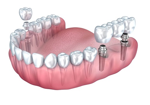 ایمپلنت-دندان-چیست