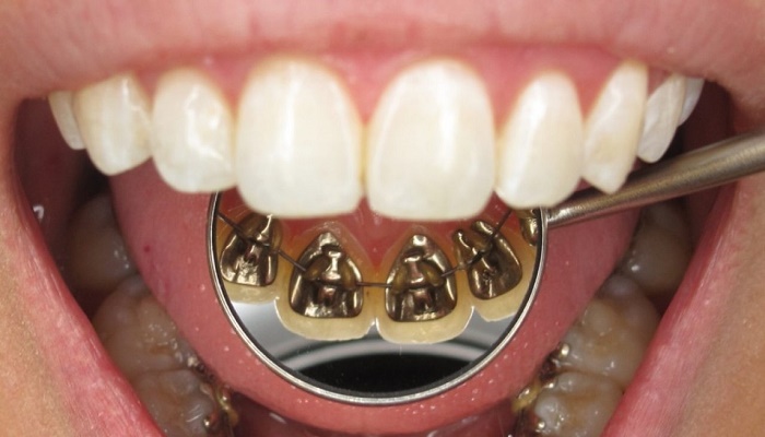 ارتودنسی-پشت-دندان