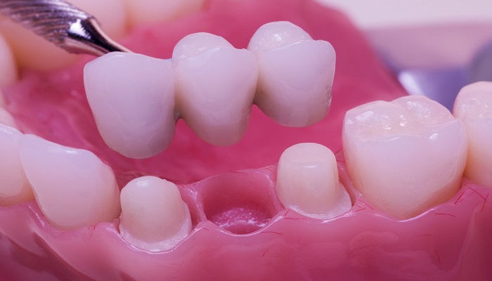پل-دندان