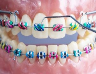 ارتودنسی-دندان-رنگی