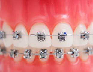 ارتودنسی دندان چه زمانی طول می کشد