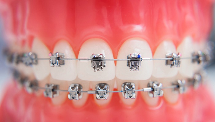 ارتودنسی دندان چه زمانی طول می کشد